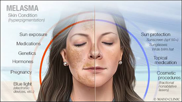 6 Cara Mengatasi Melasma Pada Wajah dan Pemicunya