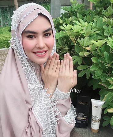 Cara Mencegah Munculnya Stretch Mark