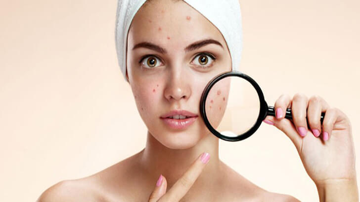 Perbedaan Purging dan Breakout Saat Mencoba Skincare Baru