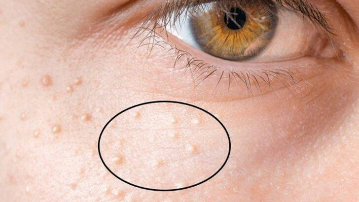 Bintik Milia di Sekitar Mata